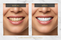 Before and After Teeth Whitening - Enhanced